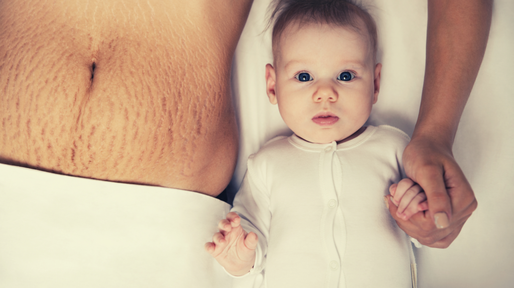 woman with diastasis recti on bed with infant